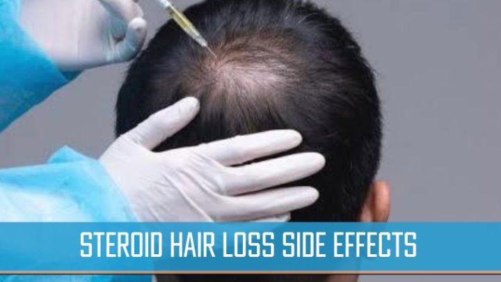 Steroid Hair Loss Side Effects